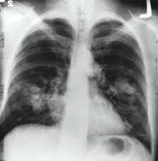 Grave de légionellose pulmonaire dépend de. Les Pathologies Respiratoires Lungo2