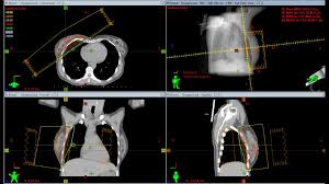 radiation therapy may cause the following side effects: This Breast Cancer Treatment Plan Is Shorter And Has Fewer Side Effects But Is Just As Effective King5 Com