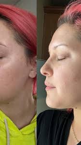 ✨PDO Afterglow✨ is a revolutionary treatment that is like having the power  of 1,000 PDO threads in a powder form, all suspended in hyaluronic acid for  the ultimate skin booster 🤌🏼🤌🏼 , Combined with ...