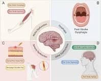Acupuncture, an effective treatment for post-stroke ...