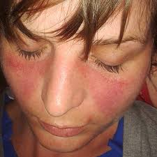 Maybe you would like to learn more about one of these? Kutaner Lupus Erythematodes Ursachen Symptome Und Therapien