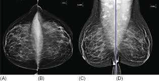 Image result for Mammogram Interpretation