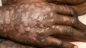 Image result for psoriasis