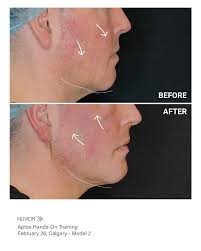 Our Feb 20th training in Toronto with top nuvior doctors in the aesthetics  field brought incredible transformations!✨️ Expert hands, lifted results,  and unstoppable energy! #Aptos Threads #NUVIORTraining #AestheticExcellenceS