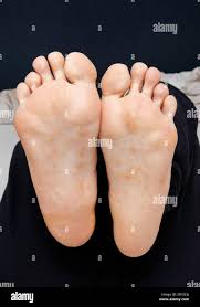 Image result for pompholyx soles of feet
