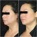 Liposuction (Ultrasonic & Tumescent) Before and After Photos ...