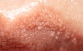 Granitos en el Pene. Urología y Procedimientos Urgentes 👌👌