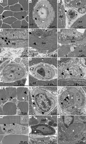 Homeadvisor's recessed lighting cost guide gives average prices to add recessed lights to an existing finished ceiling or new construction. Systemic Sclerosis Associated Myositis Features Minimal Inflammation And Characteristic Capillary Pathology Springerlink