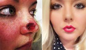 Girls and young women in new hampshire are diagnosed with the deadliest form of skin cancer at a significantly higher rate than their peers nationally, according to a state report released. Sunbed Addiction Caused Skin Cancer For This Young Nurse Express Co Uk