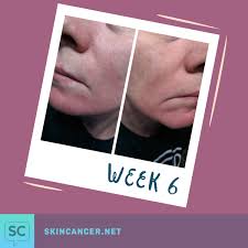 We conducted a study comparing … Mohs Surgery Pictures Post Op Photos Of The Body