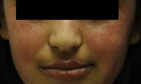 Image result for Photodermatitis