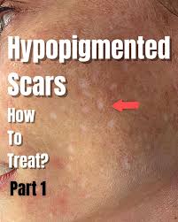 Image result for Postinflammatory Hypopigmentation