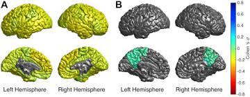 • brain protection in schizophrenia, mood and cognitive disorders. Cortical Brain Abnormalities In 4474 Individuals With Schizophrenia And 5098 Control Subjects Via The Enhancing Neuro Imaging Genetics Through Meta Analysis Enigma Consortium Biological Psychiatry