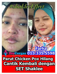Jika anda berminat untuk jana pendapatan. Pin Di Ubat Hilangkan Parut Chicken Pox