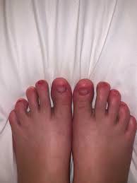 Image result for Onychotillomania feet