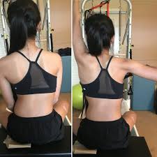 Top 3 Gifts For Scoliosis Osteopilates See more ideas about scoliosis, scoliosis quotes, scoliosis exercises. top 3 gifts for scoliosis osteopilates