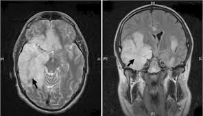 Severe viral infection of the central nervous system, caused by a mri (or ctb if mri not available). Herpes Simplex Encephalitis The Bmj