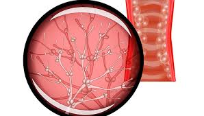 Candida albicans is the predominant cause of the disease. Candidoza Candida Albicans Ce Este De Ce Apare Riscuri Si Tratament Reginamaria Ro