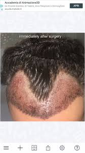 Oral dutasteride (avodart) is approved to treat hair loss in some countries, but not yet by the us fda. My Hair Transplant 8 Month Opinion I M Not Convinced About The First Line Where There Are The Singles Units Photos