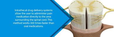 Image result for Intrathecal Pump