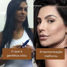✨A beleza é genética, mas o glow… esse a gente turbina por aqui! 😏 A  harmonização facial não muda quem você é — ela só realça o que você já tem  de