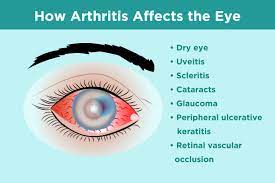 A visual field test assesses how much the ptosis affects the superior vision. Inflammatory Arthritis And Eye Health Prevention Symptoms Treatment