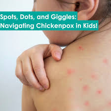 Image result for shingles in children