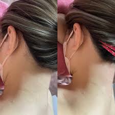 新娘颈背脱毛| 横滨青叶台斑点毛孔下垂改善专业美容美可爱