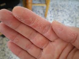 Eczema Skin Peeling On Hands Also Visit My Web Site About Eczema Only At Http Www Howtogetridofeczemafast Net Eczema On Hands Eczema Symptoms Eczema