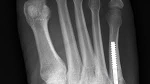 faster 5th metatarsal fracture recovery! jones fracture healing time can be slower without surgery. 4 Type Of Fifth Metatarsal Fracture