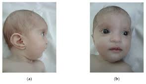 Wolf-Hirschhorn Syndrome: Clinical and Genetic Study of 7 New Cases, and  Mini Review