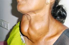 Image result for Multinodular Goiter