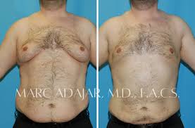 Image result for Mastectomy