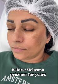 Effective Melasma Treatment: Achieve Clear Skin