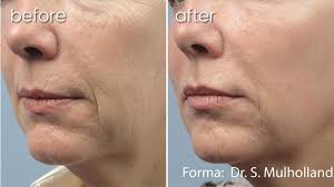 Get reviews, hours, directions, coupons and more for glow laser & aesthetics center md. Skin Tightening Bakersfield Mini Facelift Bakersfield