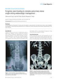 Pdf Forgotten Stent Leading To Complex Panurinary Stone Single Sitting Endourologic Management