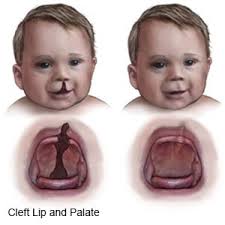 Check spelling or type a new query. Cleft Lip And Cleft Palate Repair What You Need To Know
