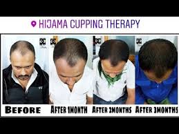 The main reason for hair loss is dht and it also destroys hair follicles. Hhijama Remedies 2020