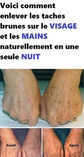 Voici Comment Enlever Les Taches Brunes Sur Le Visage Et Les Mains Naturellement En Une Seule Nuit Sweet Potato Vegetables