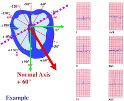 Qrs Determination