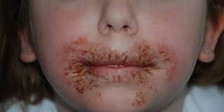 Rambut rontok dan yang tumbuh dengan karakter kecil terjadinya penyakit tinea pedis ini disebabkan oleh infeksi jamur (missal: Penyebab Kurap Di Wajah Dan Cara Mengatasinya Yang Perlu Diketahui Merdeka Com