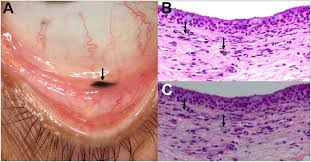 Image result for conjunctival melanoma