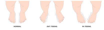 Image result for Out-toeing