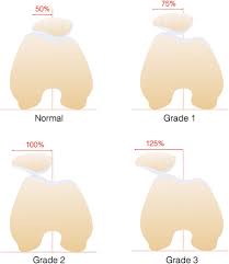 Image result for Patella Mobility Test
