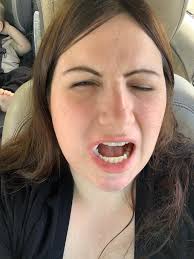 The staples came out today, but I have another complication. The incision 