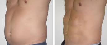 Liposuzione Addominale Maschile Chirurgia Estetica Uomo