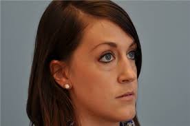 Rhinoplasty Before and After Photos by Paul Vanek, MD, FACS; Concord, OH