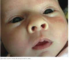 A Neonate With A Crooked Nose Consultant360