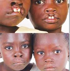 Cleft lip is a common birth defect (problem). Cleft Lip Victims Still An Imperiled Species Independent Newspaper Nigeria