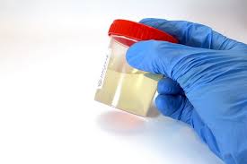 Simple Kidney Cysts Niddk
